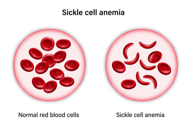 Sickle cell disease. The difference of Normal red blood cell and sickle cell. Sickle cell disease. The difference of Normal red blood cell and sickle cell. sickle cell anemia stock illustrations